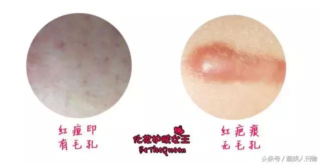 还在长痘痘还有痘坑怎么办,正在长痘怎么祛痘