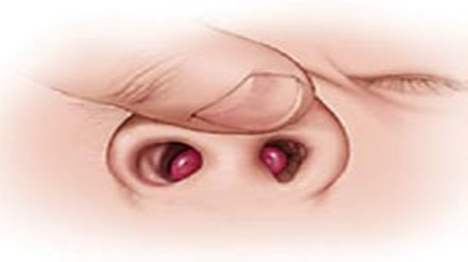 经常挖鼻孔导致鼻孔出血怎么处理,经常挖鼻孔怎么调理