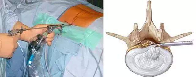 《1039生活馆》之“健康导医”：腰突手术如何不再“伤筋动骨”？