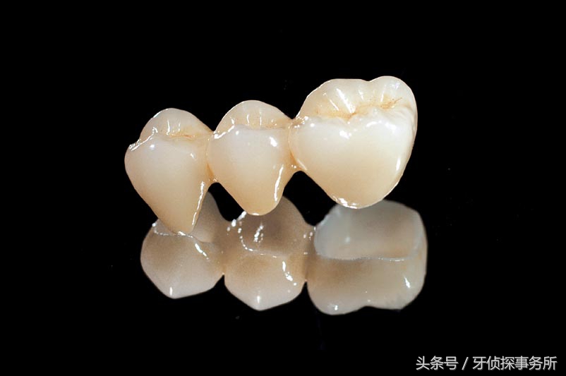 打桩后做的全瓷牙寿命是多久,韩国奥齿泰全瓷牙一般寿命多少年