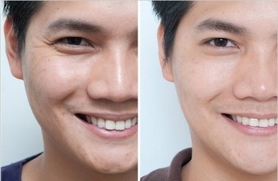 切除眼袋是唯一解决眼袋的方法,眼袋切除方法有哪些