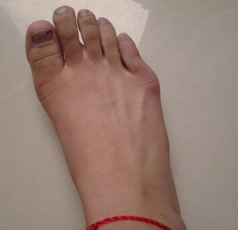 趾内翻是什么症状图片,拇内翻是什么原因造成的