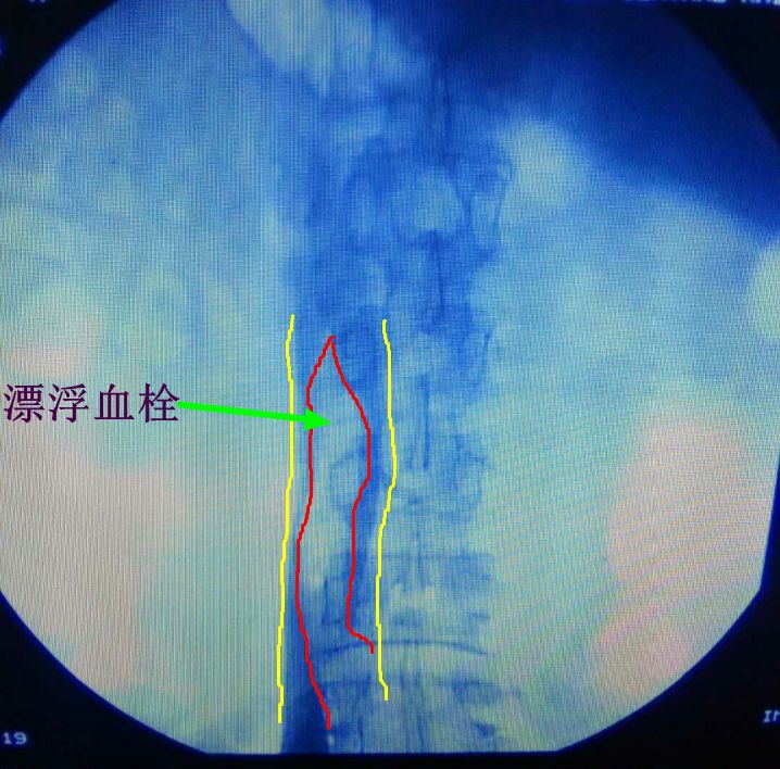 下肢静脉曲张手术后为什么会复发,下肢静脉曲张手术后复发后严重吗