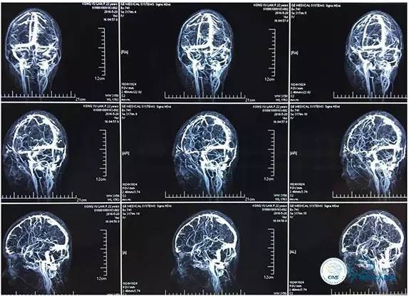 脑静脉窦狭窄做支架危险吗,静脉窦狭窄做支架后多久恢复