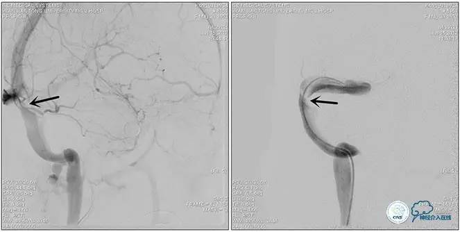 静脉窦狭窄支架植入术,静脉窦狭窄做支架多少钱