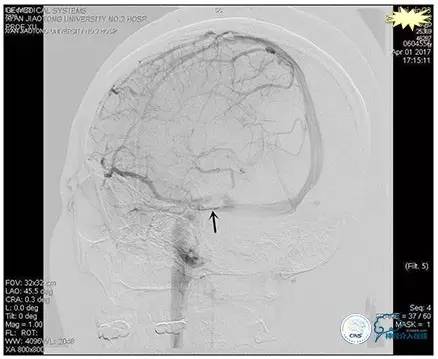脑静脉窦狭窄做支架危险吗,静脉窦狭窄做支架后多久恢复