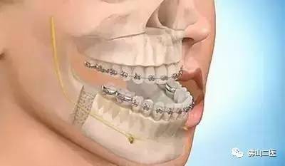「医生说」“地包天”不容忽视口腔正畸专家提醒，越早接受治疗效果越好