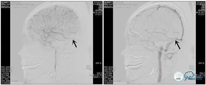 静脉窦狭窄支架植入术,静脉窦狭窄做支架多少钱