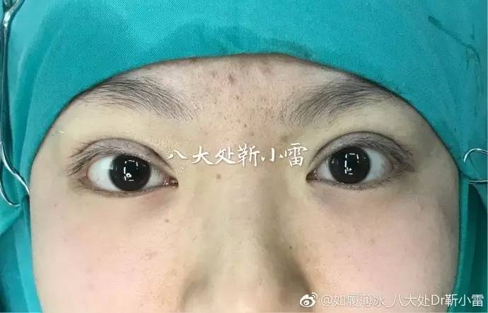 为什么医生不肯为她做双眼皮手术？