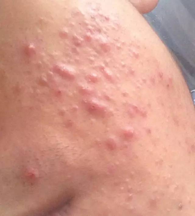 战痘合集完整版,战痘大结局完整版