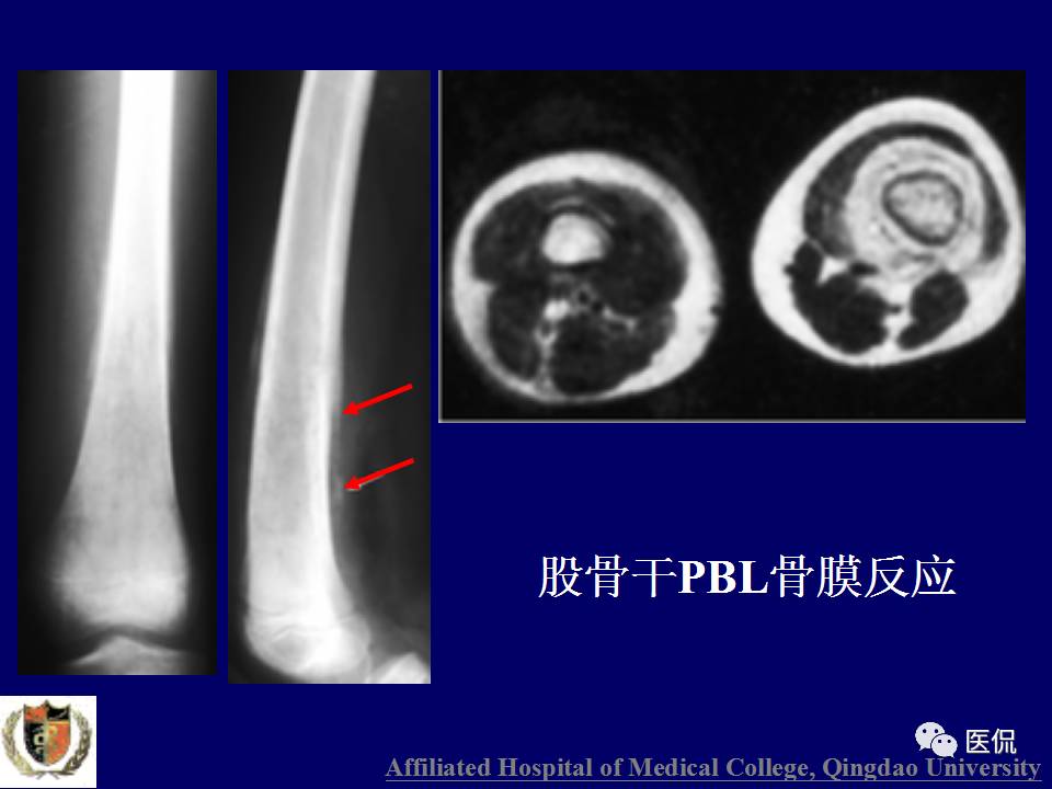 徐文坚老师精讲：原发性骨淋巴瘤影像学诊断医学影像精品PPT