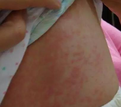 15岁男童输液过敏休克,小孩突然呕吐休克