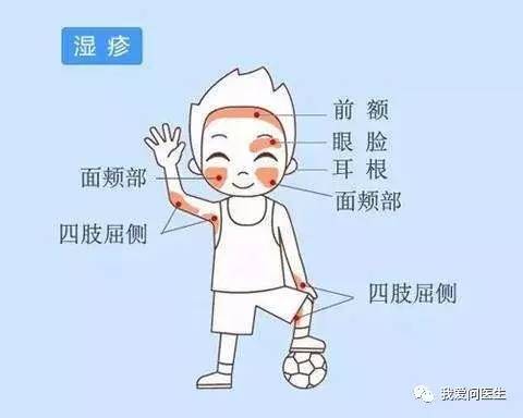 湿疹不用怕3个小妙招轻松应对,科普牢记这几招湿疹不再可怕