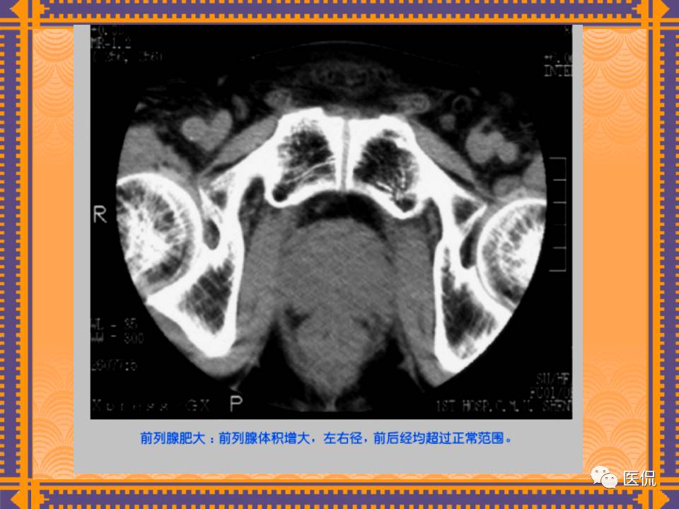 生殖系统疾病影像学诊断医学影像精品PPT