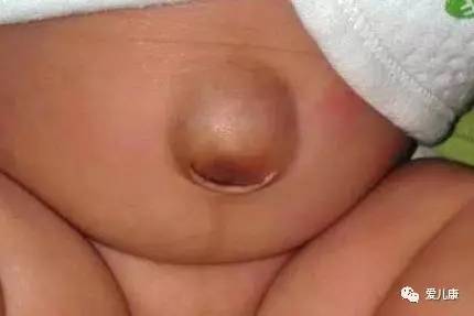 宝宝肚脐鼓鼓的是什么原因,宝宝肚脐鼓了个包
