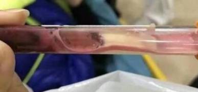 一岁男孩吃了它后停止发育,男孩吃鸡蛋太多却全身发青