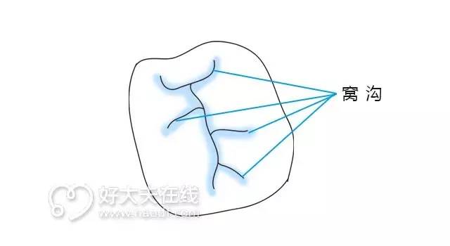 总塞牙怎么办,经常塞牙造成坏牙