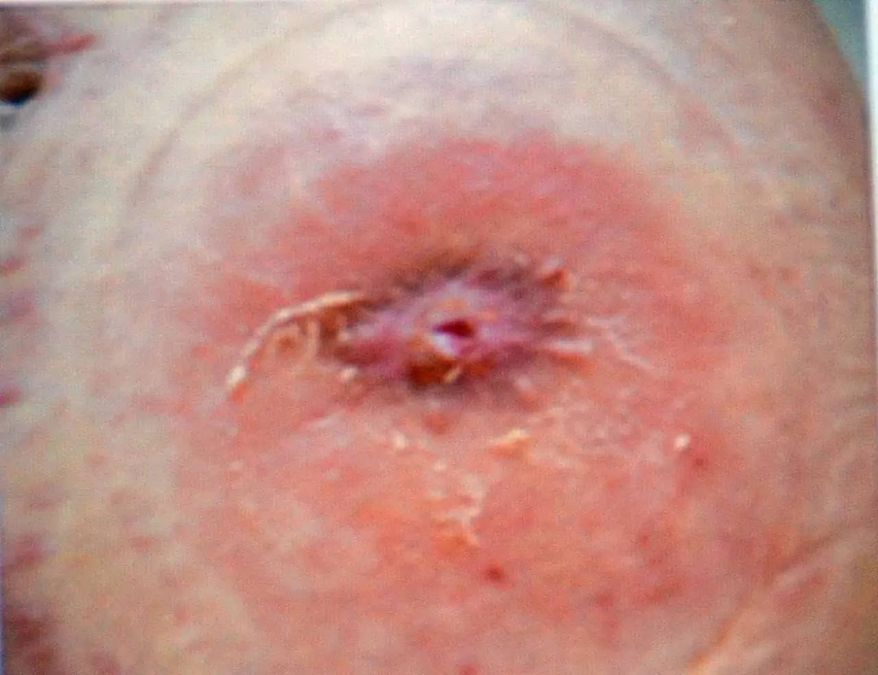 肠造口回纳的并发症是什么,膀胱全切肠造口有什么并发症