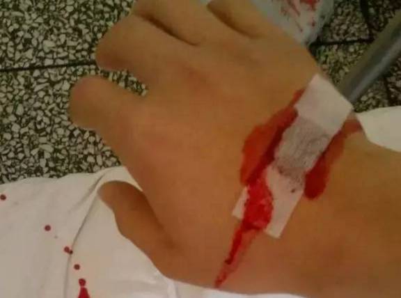 扎针如何进针不疼,怎么扎针最稳不鼓