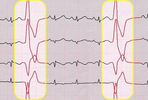 心悸导致呼吸困难,心悸导致严重口渴