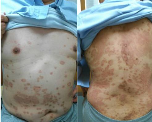 顶尖银屑病专家,10月28号世界银屑病日健康讲座