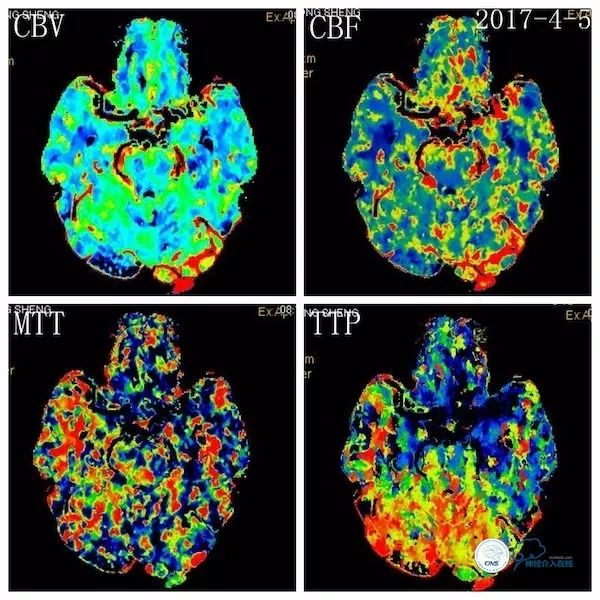 天坛医院脑血管狭窄手术做得好吗,天坛医院动脉狭窄介入手术费用