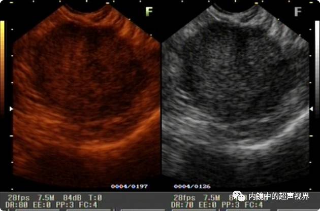 超声内镜美图攻略——动态范围与伪彩