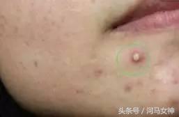 抗痘填坑,抗痘期间忌口大全