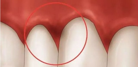 娌荤枟鐗欓緢鑲跨棝鐨勫皬鏂规硶,鐗欓緢鑲跨棝鎬庝箞鏀捐娌荤枟