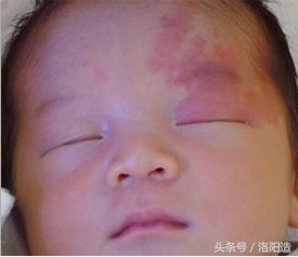 激光祛鲜红斑痣,鲜红斑痣综合征