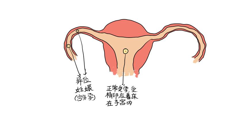 孕早期出血不要惊慌,孕16周胎盘出血能打黄体酮保胎么