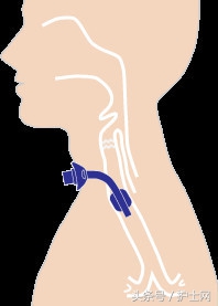 气管切开病人的护理措施存在问题,气管切开卧床病人的三大并发症