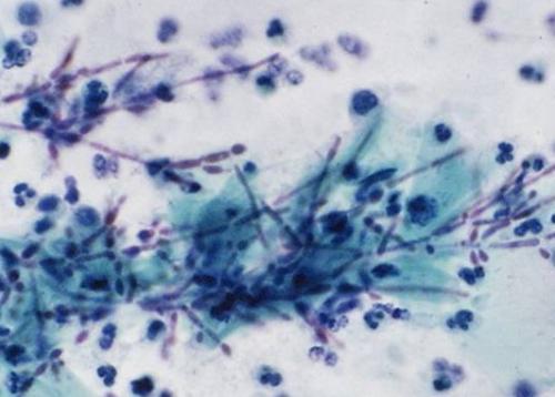 为什么把脚气叫香港脚,足癣为什么叫做香港脚