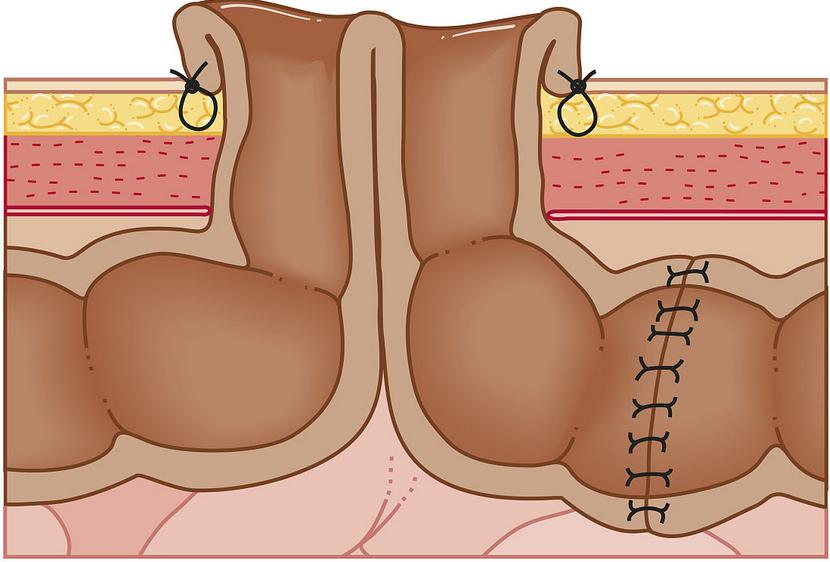癌症造口怎么护理,肿瘤患者的护理诊断及护理措施ppt