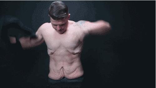 减肥后皮肤松弛最好的解决方法,减肥最怕皮肤松弛如何预防与拯救