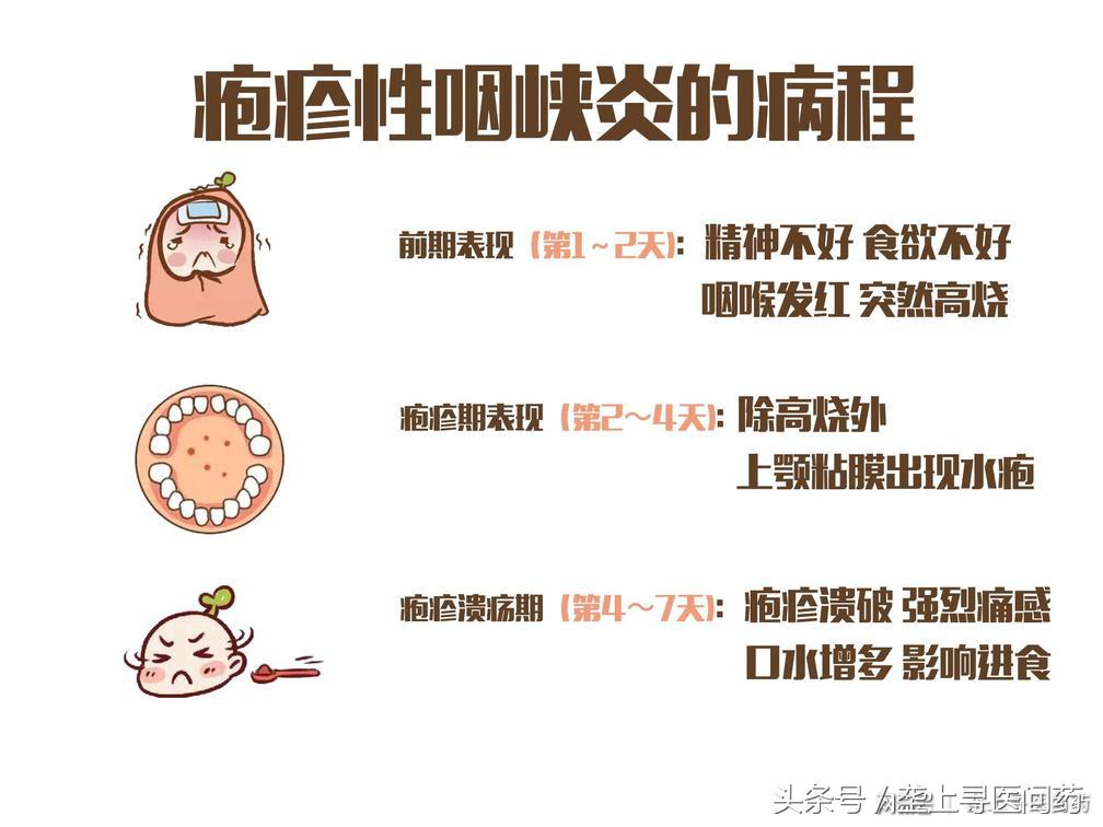 疱疹性咽峡炎高烧不退是怎么回事,宝宝高烧不退一定要小心这种病