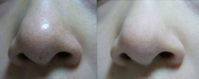 比较温和的去黑头方法,现在比较靠谱的去黑头方法