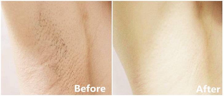 全球顶级脱毛膏,一款很牛的脱毛膏