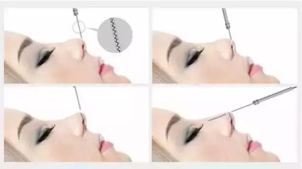 鼻子不好看的女性,线雕鼻做好鼻梁太细是什么原因