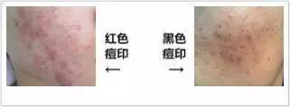 祛痘印祛痘坑最有效的方法,痘印的克星的药膏