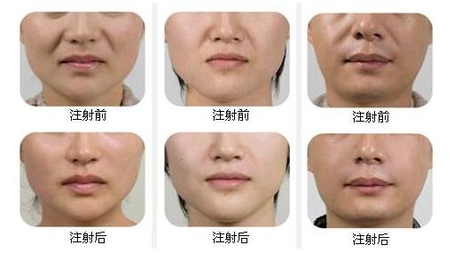 玻尿酸美容的正确方法,玻尿酸又称午餐式美容