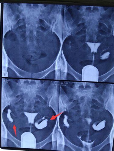 做输卵管造影前后注意事项,输卵管造影三维超声后注意些什么