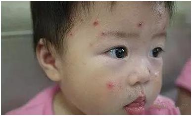 出疹时间顺序口诀,猩红热出疹顺序口诀