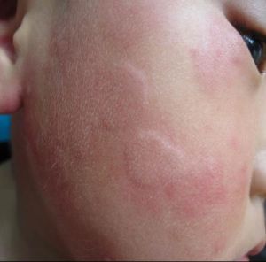 痒痒痒！得了*麻疹荨**怎么办？