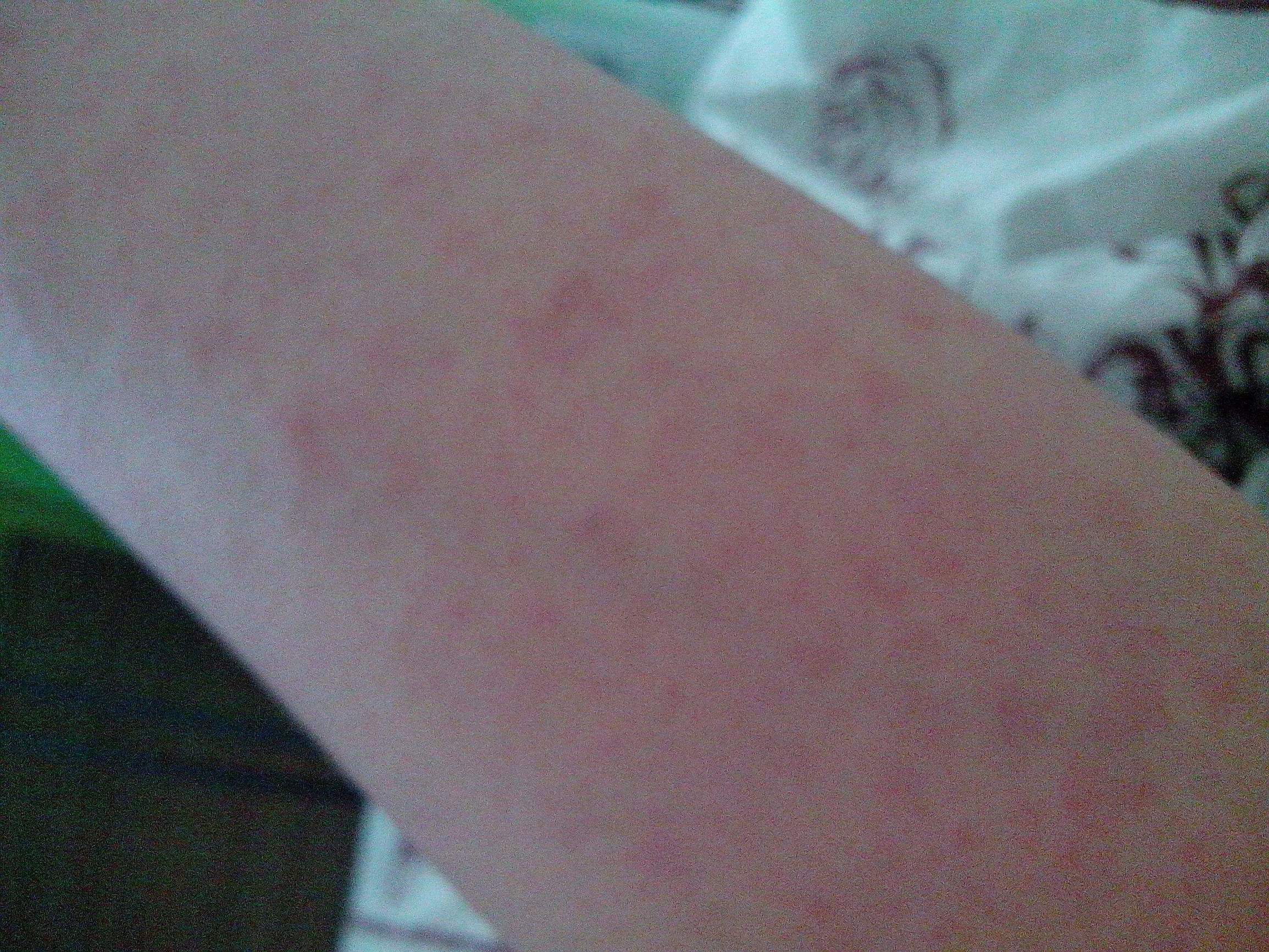 有像痣一样的小红点不痛不痒,身上长小红点像小白点