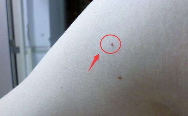 身上长小红点不痛不痒变成黑点,身上长红点像红色小痣怎么回事