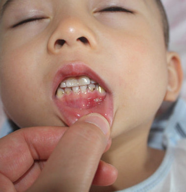 2岁宝宝老是得咽峡炎疱疹,得了疱疹性咽峡炎还会有手足口吗