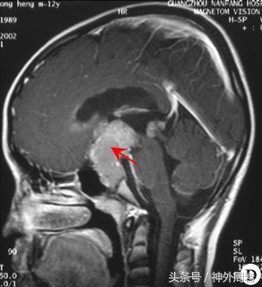 泌乳素型垂体瘤能用中药治愈吗,泌乳素腺瘤可以吃药吗