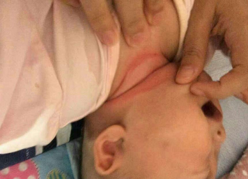 防止宝宝脖子被淹擦什么,宝宝脖子被淹为什么要用茶水洗