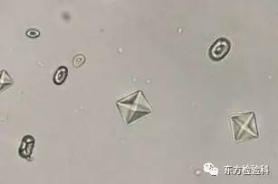 孕妇尿结晶数值多少是结石,尿结晶数量高看什么科